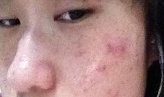 额头长痘痘了怎么办